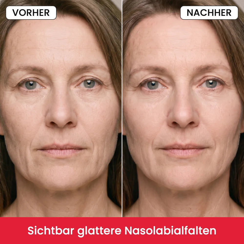 Vorher/Nachher: Gesicht mit sichtbar glatteren Nasolabialfalten, Symbolbild